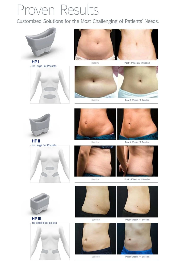 New Released Cryolipolisis Fat Freezing Machine 6