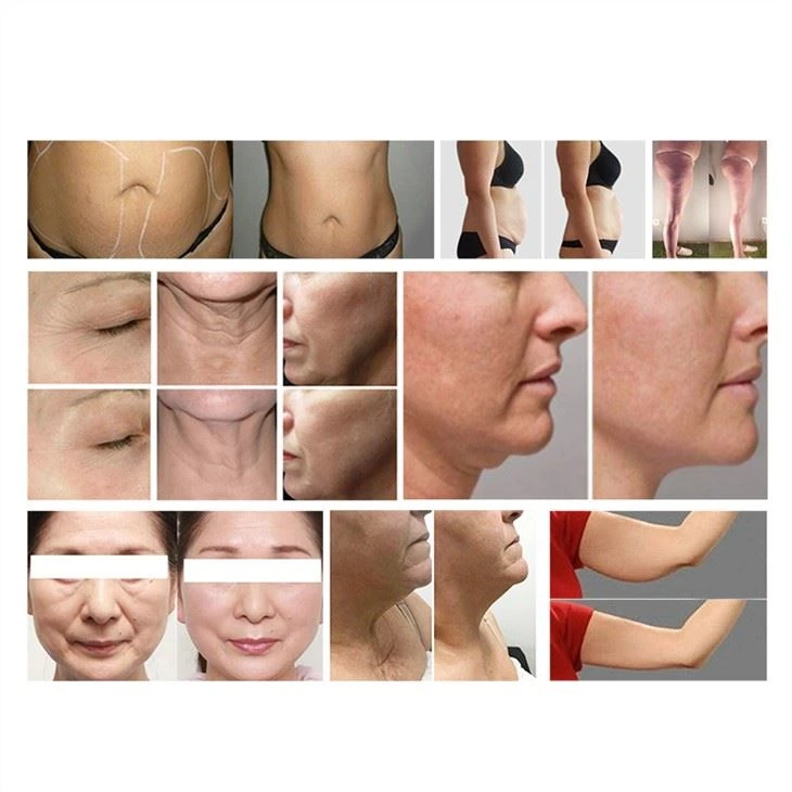 Vacuum Roller RF Body Sculpting Slimming Synergy Face Lifting Machine