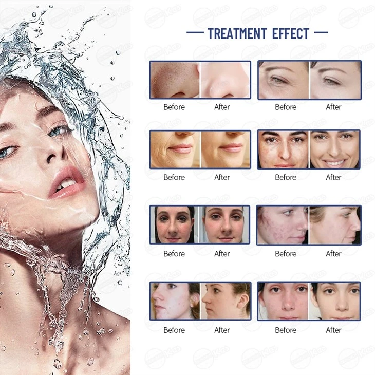 Most Popular Skin Care Multifunctional H2O2 Skin Care Machine best