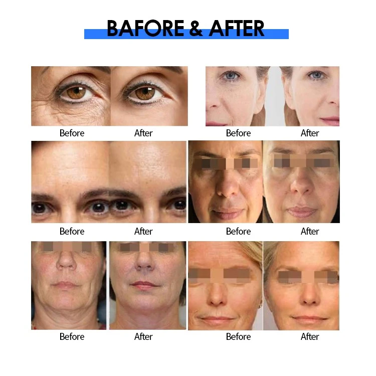 RF beauty machine treatment RF beauty machine treatment